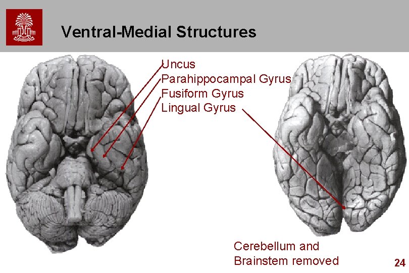 Ventral-Medial Structures Uncus Parahippocampal Gyrus Fusiform Gyrus Lingual Gyrus Cerebellum and Brainstem removed 24 Ventral-Medial Structures Uncus Parahippocampal Gyrus Fusiform Gyrus Lingual Gyrus Cerebellum and Brainstem removed 24