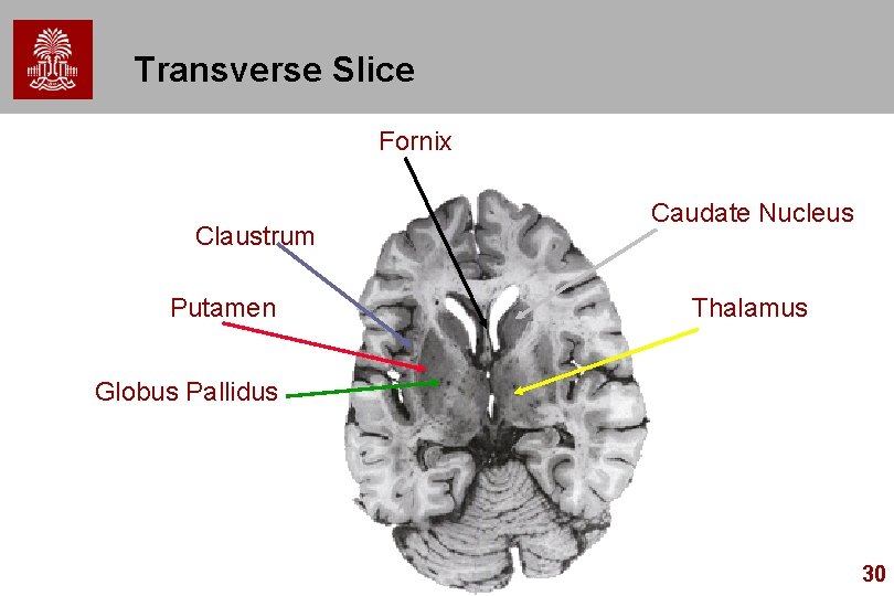 Transverse Slice Fornix Claustrum Putamen Caudate Nucleus Thalamus Globus Pallidus 30 Transverse Slice Fornix Claustrum Putamen Caudate Nucleus Thalamus Globus Pallidus 30