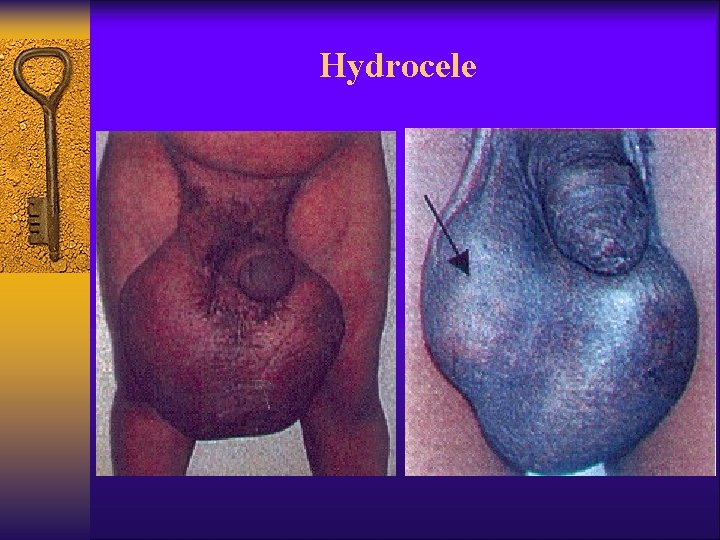 Hydrocele 