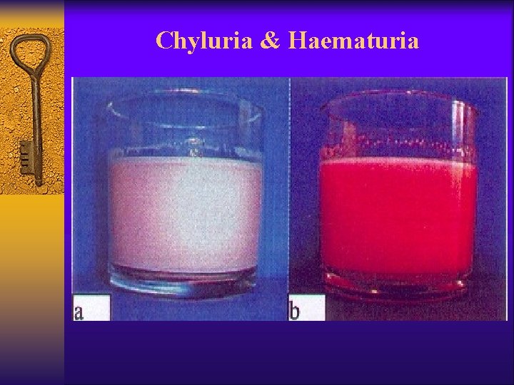 Chyluria & Haematuria 