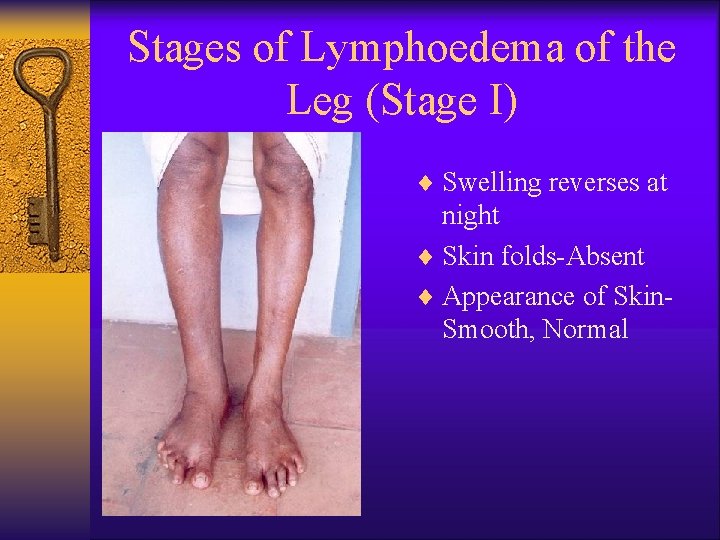 Stages of Lymphoedema of the Leg (Stage I) ¨ Swelling reverses at night ¨