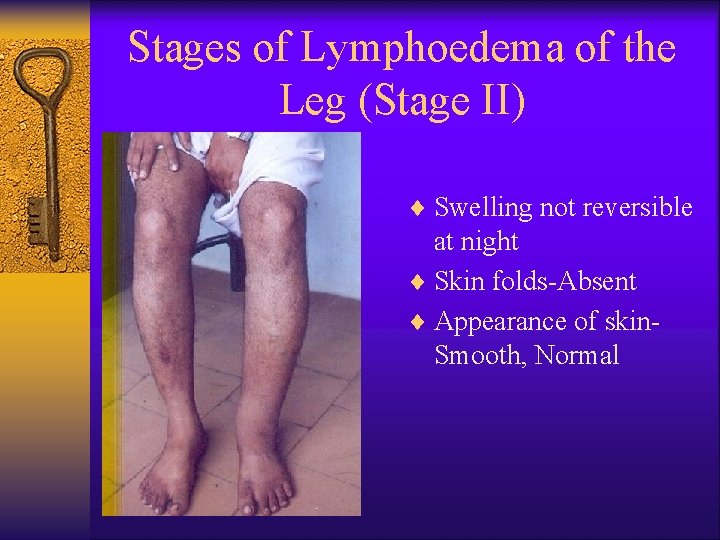 Stages of Lymphoedema of the Leg (Stage II) ¨ Swelling not reversible at night