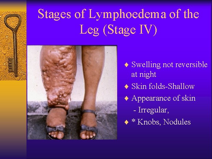 Stages of Lymphoedema of the Leg (Stage IV) ¨ Swelling not reversible at night