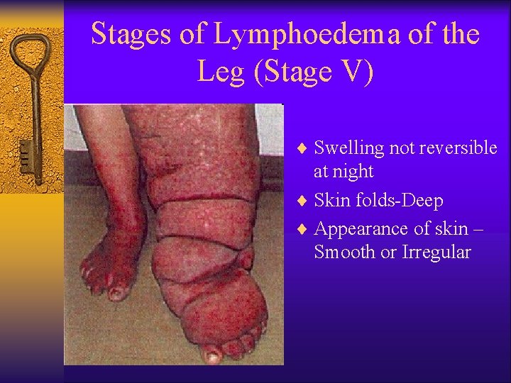 Stages of Lymphoedema of the Leg (Stage V) ¨ Swelling not reversible at night