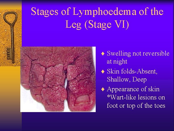 Stages of Lymphoedema of the Leg (Stage VI) ¨ Swelling not reversible at night