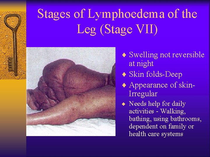 Stages of Lymphoedema of the Leg (Stage VII) ¨ Swelling not reversible at night