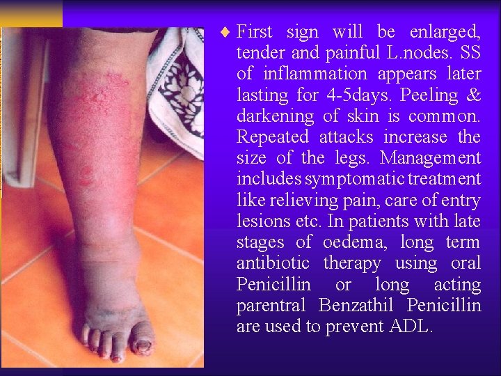 ¨ First sign will be enlarged, tender and painful L. nodes. SS of inflammation