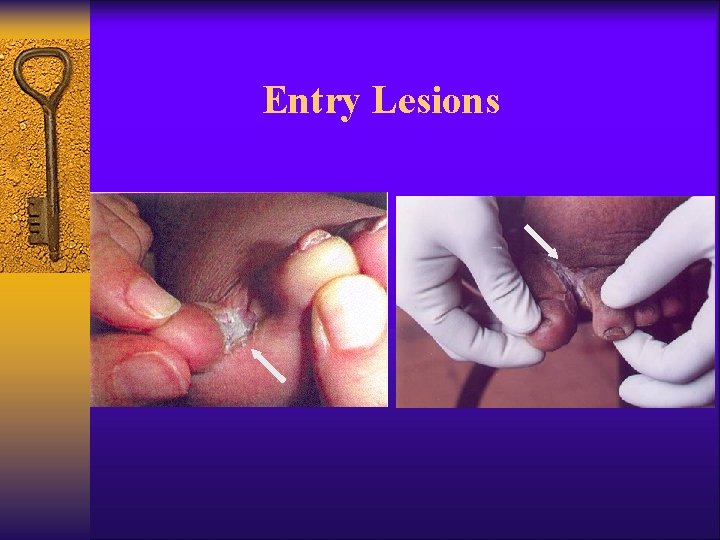 Entry Lesions 