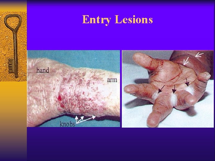 Entry Lesions 