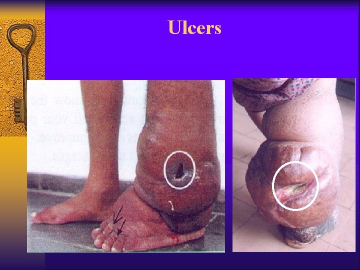 Ulcers 