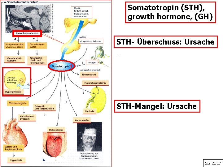 Somatotropin (STH), growth hormone, (GH) STH- Überschuss: Ursache - STH-Mangel: Ursache SS 2017 