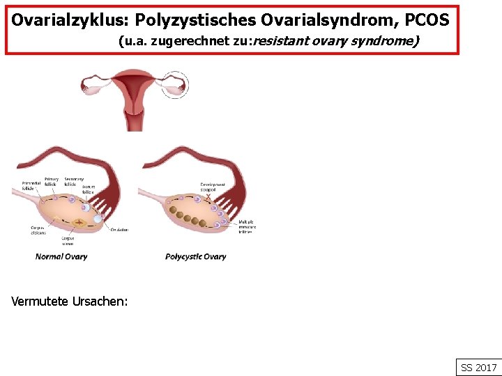 Ovarialzyklus: Polyzystisches Ovarialsyndrom, PCOS (u. a. zugerechnet zu: resistant ovary syndrome) Vermutete Ursachen: SS