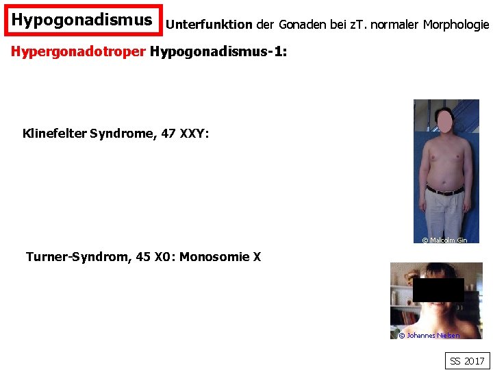 Hypogonadismus Unterfunktion der Gonaden bei z. T. normaler Morphologie Hypergonadotroper Hypogonadismus-1: Klinefelter Syndrome, 47
