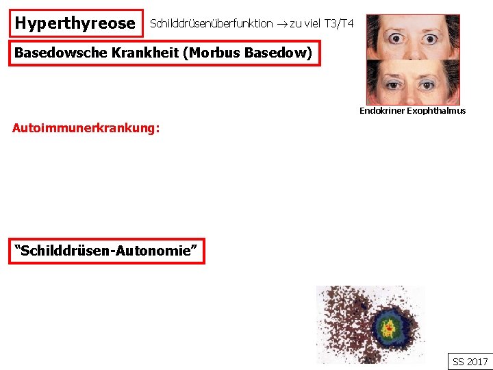 Hyperthyreose Schilddrüsenüberfunktion zu viel T 3/T 4 Basedowsche Krankheit (Morbus Basedow) Endokriner Exophthalmus Autoimmunerkrankung: