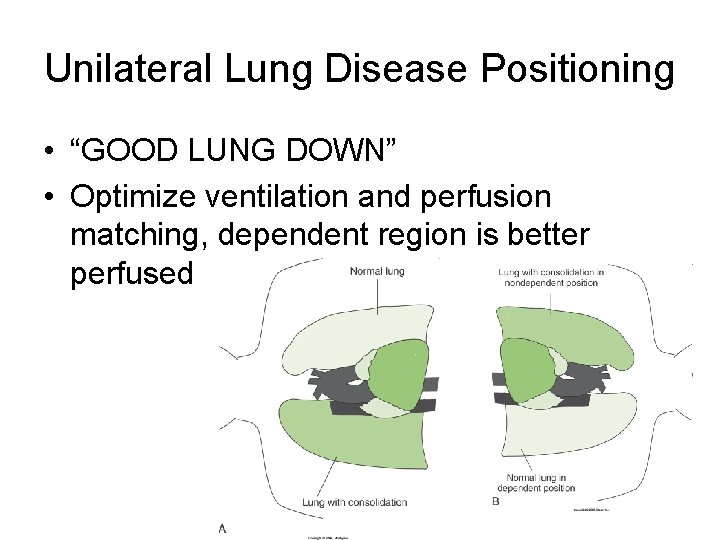 Unilateral Lung Disease Positioning • “GOOD LUNG DOWN” • Optimize ventilation and perfusion matching, Unilateral Lung Disease Positioning • “GOOD LUNG DOWN” • Optimize ventilation and perfusion matching,