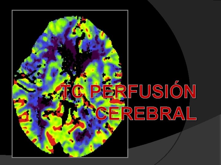 TC PERFUSIÓN CEREBRAL 