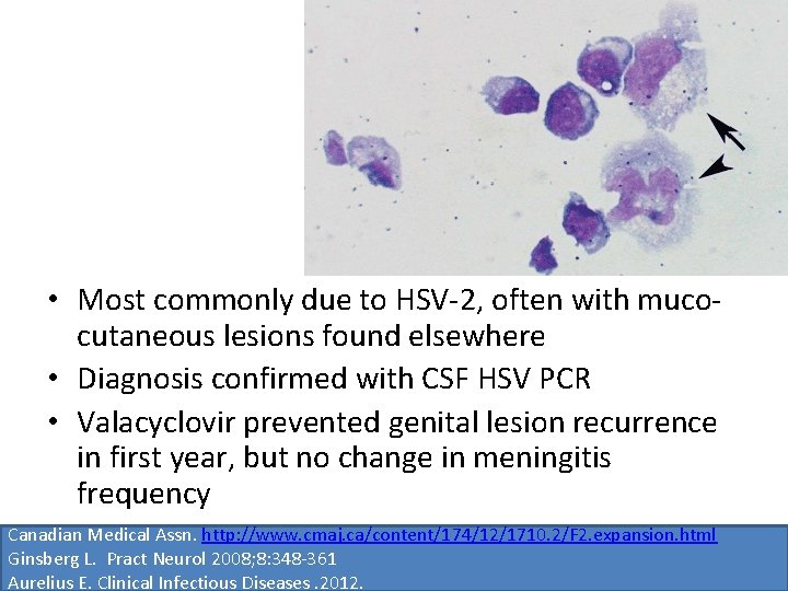  • Most commonly due to HSV-2, often with mucocutaneous lesions found elsewhere •
