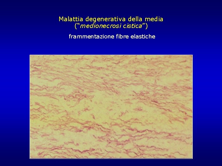 Malattia degenerativa della media (“medionecrosi cistica”) frammentazione fibre elastiche Malattia degenerativa della media (“medionecrosi cistica”) frammentazione fibre elastiche