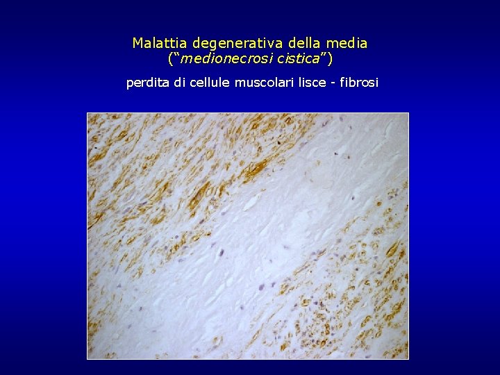 Malattia degenerativa della media (“medionecrosi cistica”) perdita di cellule muscolari lisce - fibrosi Malattia degenerativa della media (“medionecrosi cistica”) perdita di cellule muscolari lisce - fibrosi
