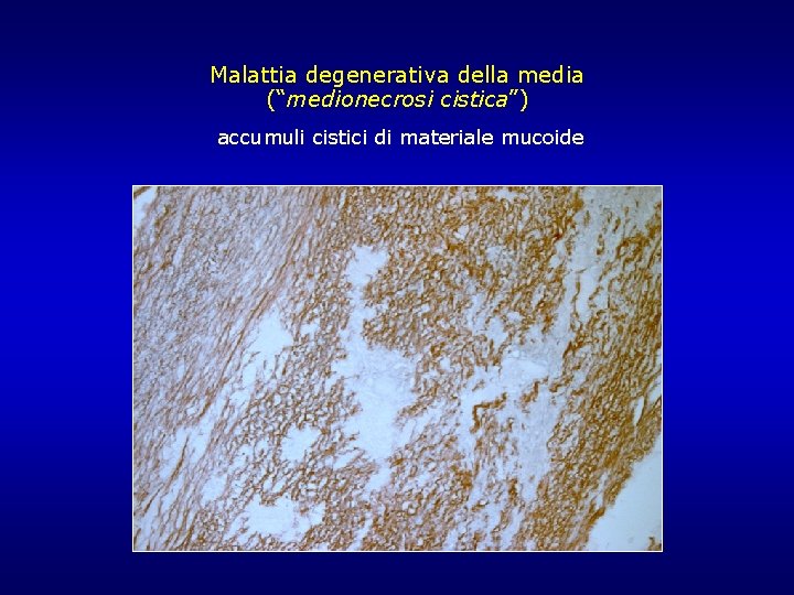 Malattia degenerativa della media (“medionecrosi cistica”) accumuli cistici di materiale mucoide Malattia degenerativa della media (“medionecrosi cistica”) accumuli cistici di materiale mucoide