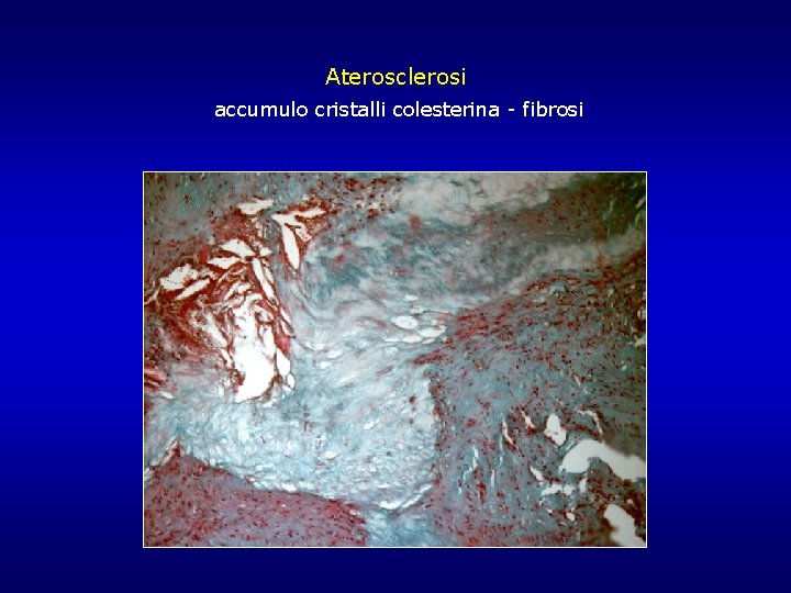 Aterosclerosi accumulo cristalli colesterina - fibrosi Aterosclerosi accumulo cristalli colesterina - fibrosi