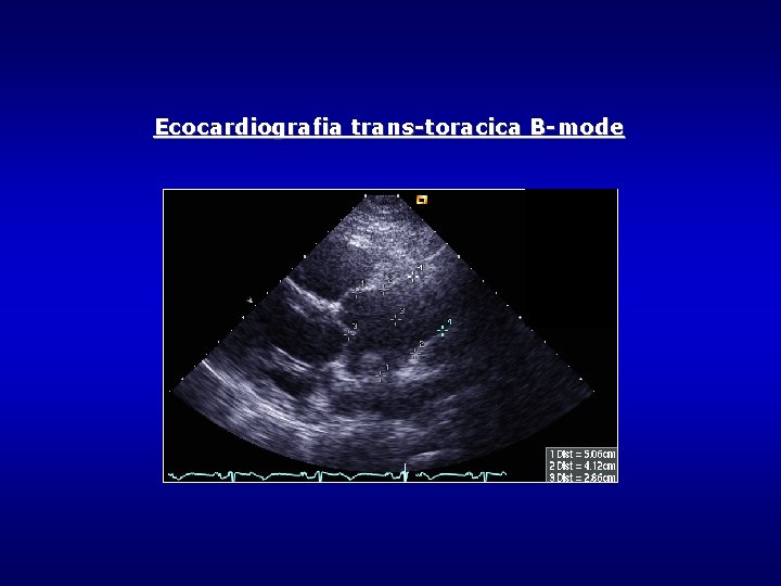 Ecocardiografia trans-toracica B-mode Ecocardiografia trans-toracica B-mode
