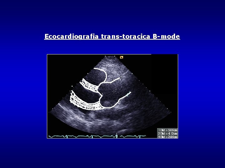 Ecocardiografia trans-toracica B-mode Ecocardiografia trans-toracica B-mode