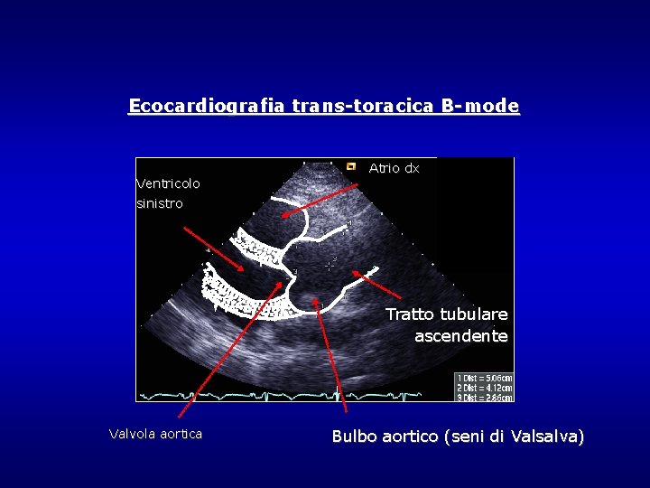 Ecocardiografia trans-toracica B-mode Ventricolo Atrio dx sinistro Tratto tubulare ascendente Valvola aortica Bulbo aortico Ecocardiografia trans-toracica B-mode Ventricolo Atrio dx sinistro Tratto tubulare ascendente Valvola aortica Bulbo aortico