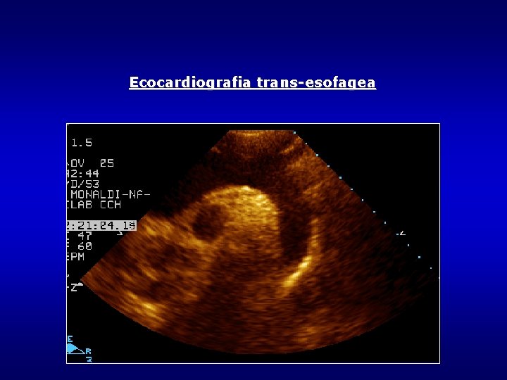 Ecocardiografia trans-esofagea Ecocardiografia trans-esofagea