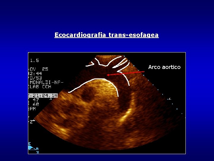 Ecocardiografia trans-esofagea Arco aortico Ecocardiografia trans-esofagea Arco aortico