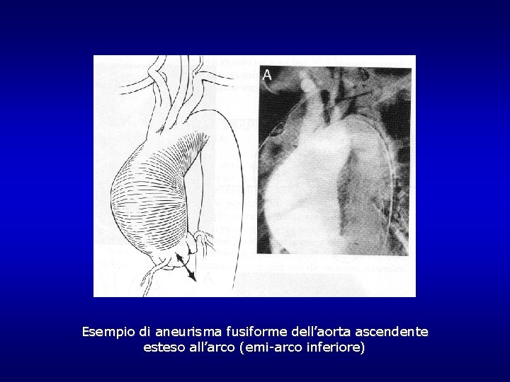 Esempio di aneurisma fusiforme dell’aorta ascendente esteso all’arco (emi-arco inferiore) Esempio di aneurisma fusiforme dell’aorta ascendente esteso all’arco (emi-arco inferiore)