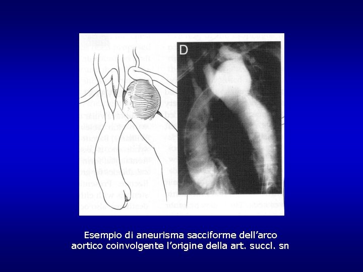 Esempio di aneurisma sacciforme dell’arco aortico coinvolgente l’origine della art. succl. sn Esempio di aneurisma sacciforme dell’arco aortico coinvolgente l’origine della art. succl. sn