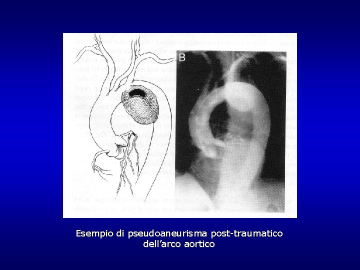 Esempio di pseudoaneurisma post-traumatico dell’arco aortico Esempio di pseudoaneurisma post-traumatico dell’arco aortico