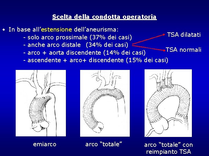 Scelta della condotta operatoria • In base all’estensione dell’aneurisma: TSA dilatati - solo arco Scelta della condotta operatoria • In base all’estensione dell’aneurisma: TSA dilatati - solo arco