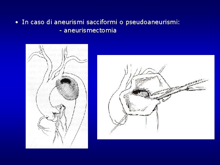 • In caso di aneurismi sacciformi o pseudoaneurismi: - aneurismectomia • In caso di aneurismi sacciformi o pseudoaneurismi: - aneurismectomia