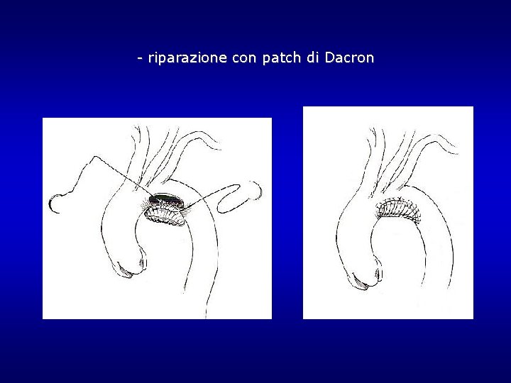 - riparazione con patch di Dacron - riparazione con patch di Dacron