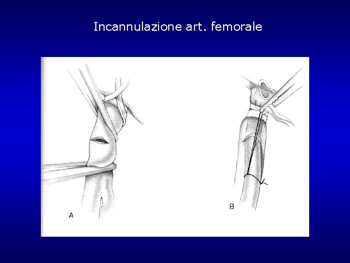 Incannulazione art. femorale Incannulazione art. femorale
