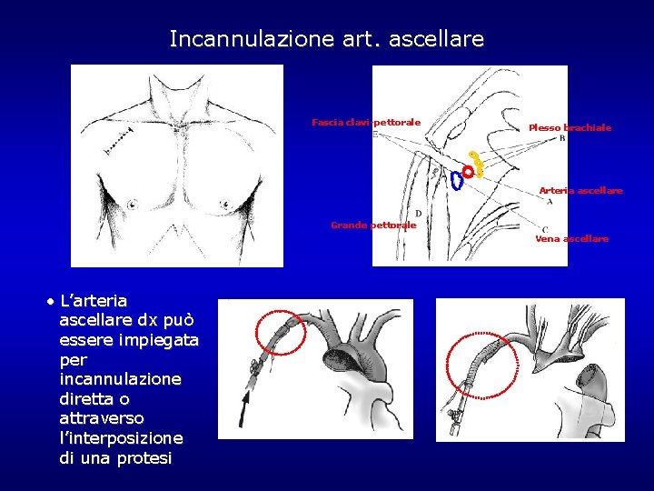 Incannulazione art. ascellare Fascia clavi-pettorale Plesso brachiale Arteria ascellare Grande pettorale Vena ascellare • Incannulazione art. ascellare Fascia clavi-pettorale Plesso brachiale Arteria ascellare Grande pettorale Vena ascellare •