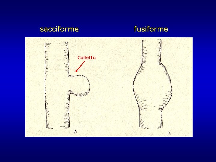 sacciforme Colletto fusiforme sacciforme Colletto fusiforme