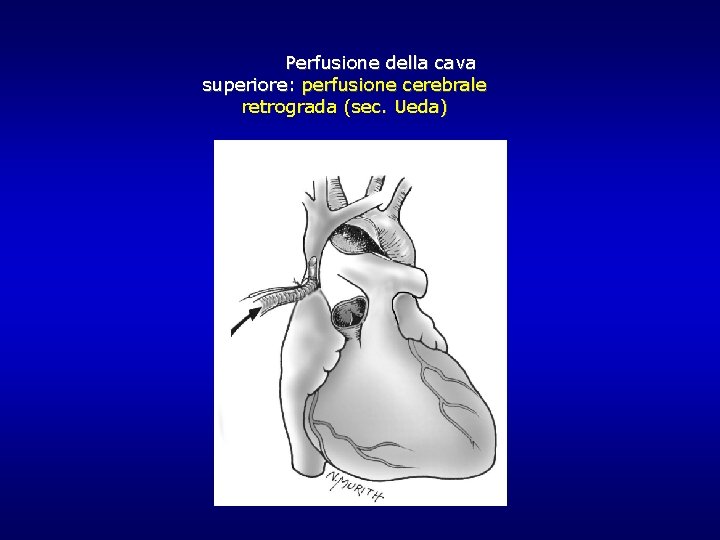 Perfusione della cava superiore: perfusione cerebrale retrograda (sec. Ueda) Perfusione della cava superiore: perfusione cerebrale retrograda (sec. Ueda)