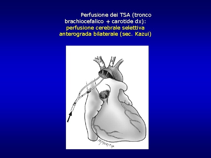Perfusione dei TSA (tronco brachiocefalico + carotide dx): perfusione cerebrale selettiva anterograda bilaterale (sec. Perfusione dei TSA (tronco brachiocefalico + carotide dx): perfusione cerebrale selettiva anterograda bilaterale (sec.