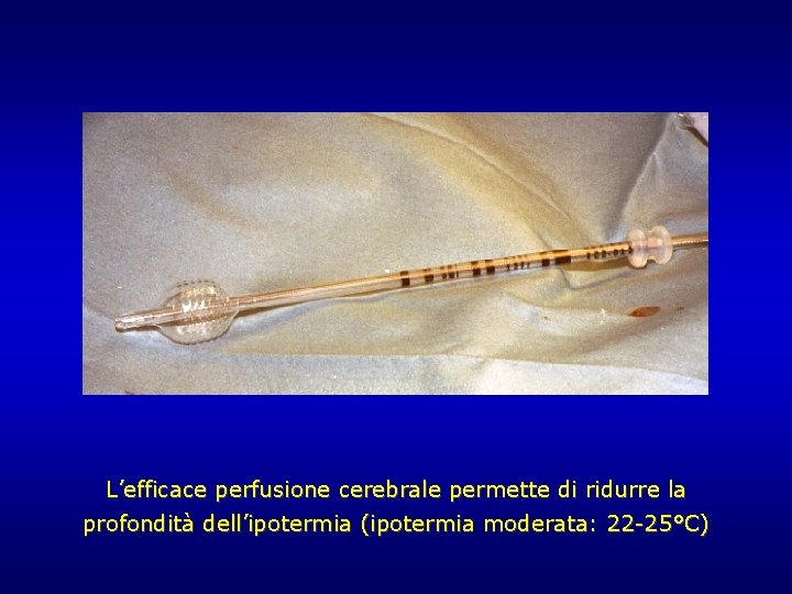 L’efficace perfusione cerebrale permette di ridurre la profondità dell’ipotermia (ipotermia moderata: 22 -25°C) L’efficace perfusione cerebrale permette di ridurre la profondità dell’ipotermia (ipotermia moderata: 22 -25°C)