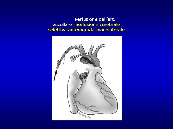 Perfusione dell’art. ascellare: perfusione cerebrale selettiva anterograda monolaterale Perfusione dell’art. ascellare: perfusione cerebrale selettiva anterograda monolaterale
