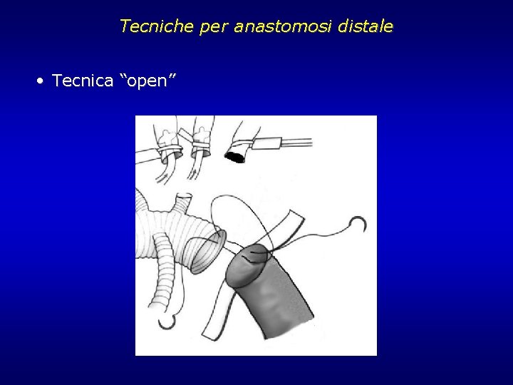 Tecniche per anastomosi distale • Tecnica “open” Tecniche per anastomosi distale • Tecnica “open”