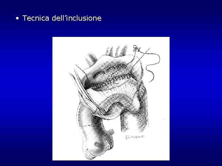 • Tecnica dell’inclusione • Tecnica dell’inclusione