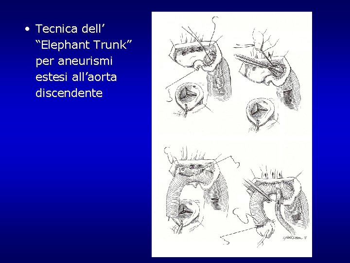 • Tecnica dell’ “Elephant Trunk” per aneurismi estesi all’aorta discendente • Tecnica dell’ “Elephant Trunk” per aneurismi estesi all’aorta discendente