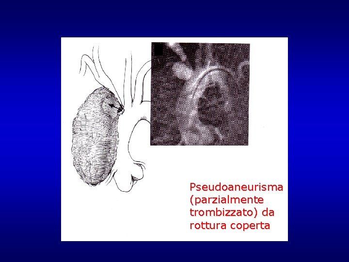 Pseudoaneurisma (parzialmente trombizzato) da rottura coperta Pseudoaneurisma (parzialmente trombizzato) da rottura coperta