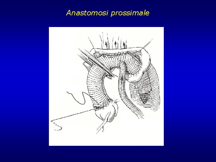Anastomosi prossimale Anastomosi prossimale