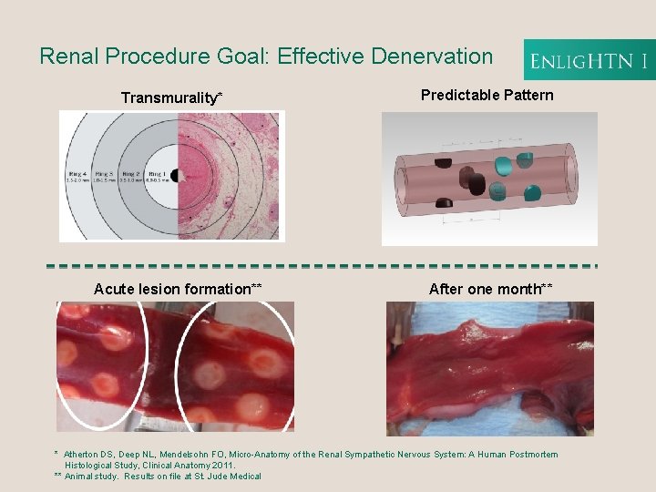 Renal Procedure Goal: Effective Denervation Transmurality* Acute lesion formation** Predictable Pattern After one month**