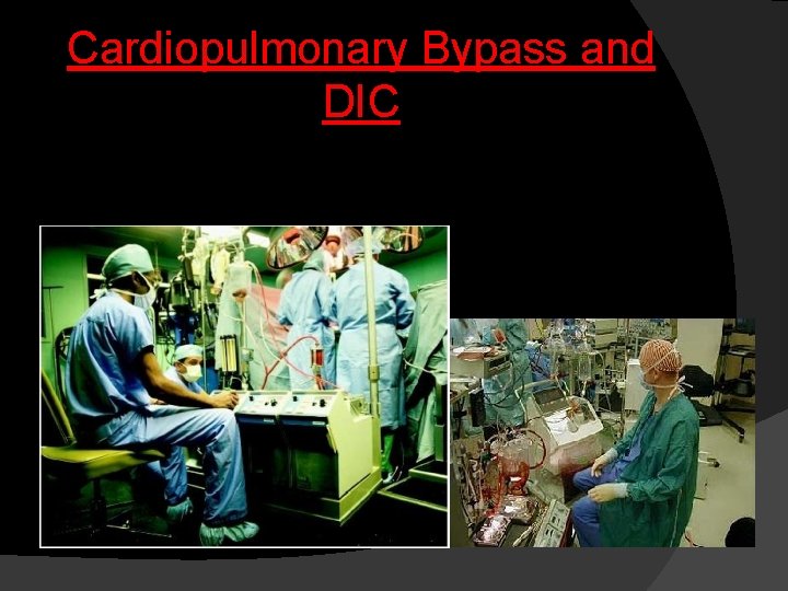 Cardiopulmonary Bypass and DIC 